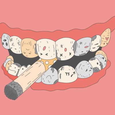 Effects of tobacco smoking on Oral Health & Teeth