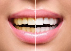 All You Need to Know About Teeth Whitening	
