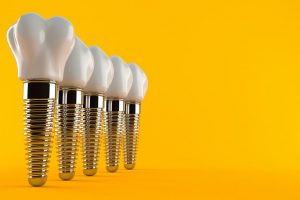 Dental Implants – Advantages and Disadvantages
