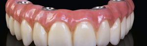 Improved Solution To Avoid Toothless Jaw
