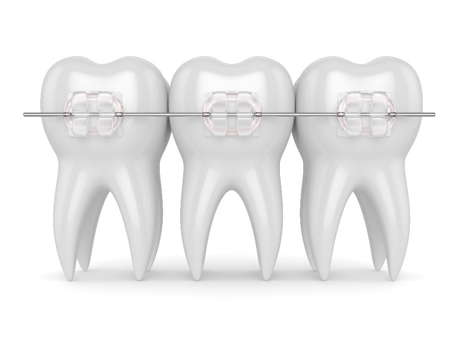 Ceramic braces